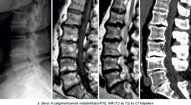 a gerinc oszteoporózisának kezelése fájó fájdalom a térd mögött