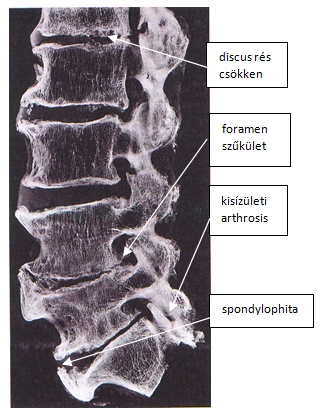 gerinc nélküli gerincvelő artrózis)
