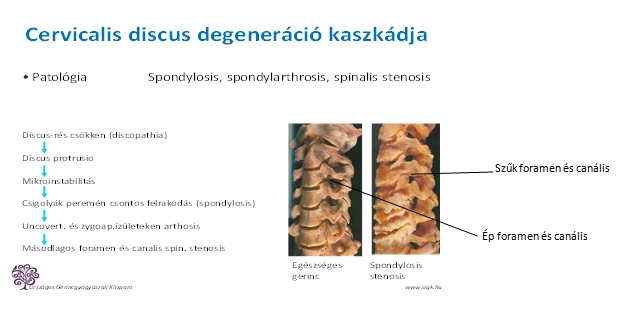 Osteophytadiscus complex