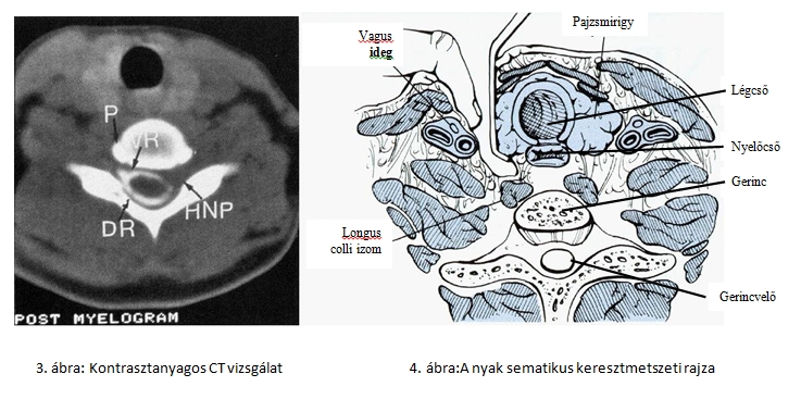CT vizsgálat, CT vizsgálat kontrasztanyaggal, a nyak anatómiája