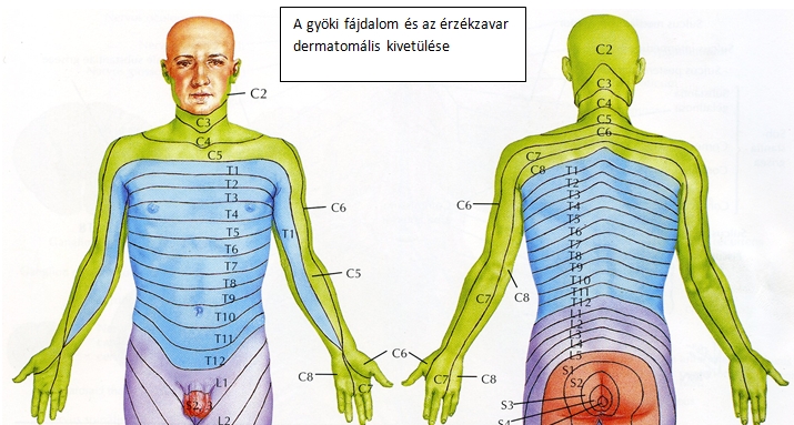 kompressziós fájdalom a gerincben fájdalom a hát alsó részén és a bal csípőben