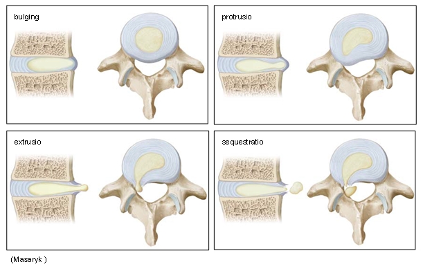 A nyaki gerinc artrózisa c5-c6 kezelés, Discopathia vagy polydiscopathia?