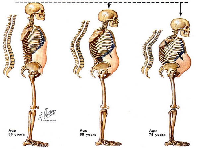 A csontritkulás (oszteoporózis) előjelei és veszélyei