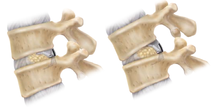 ii fokú deformáló láb artrózis és kezelés hogyan kell kezelni a csípőízületek csontritkulását