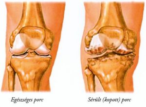 akut osteoarthritis fájó fájdalom a térdízületben