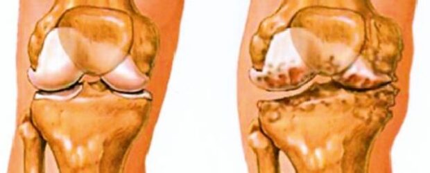 A térdízületi artrózisról - Goodwill Pharma - Webshop