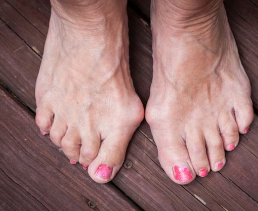 a nagy lábujjak ízületeinek ízületi gyulladásainak kezelése
