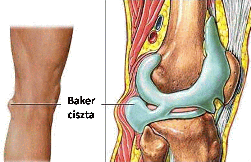 térdízület osteoarthrosis kezelése 1 fokos