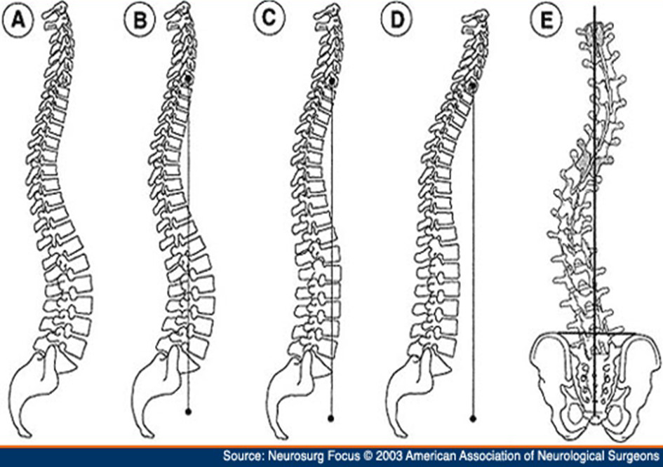 a gerinc keresztcsontjának kezelése nyaki osteochondrosis súlyos fájdalom
